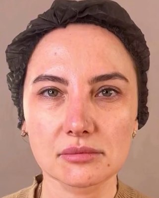 Antes e depois — Método REVER, paciente 2